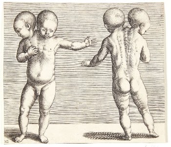 A deformed child with two | Free Photo - rawpixel