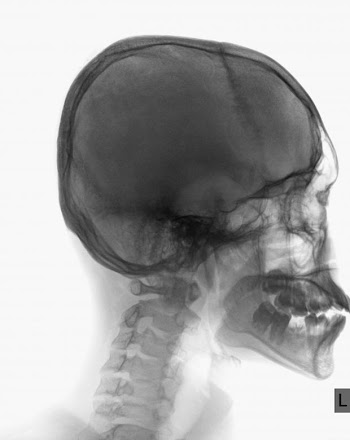 A Schedel AP radiograph of the skull on white background