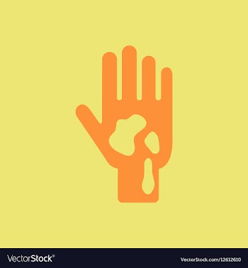 Allergic stains on hand various symptoms of vector image