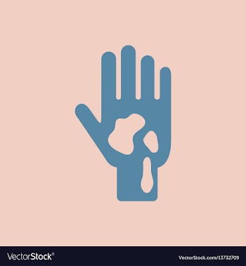 Allergic stains on hand various symptoms of vector image