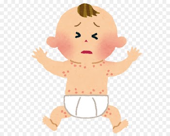 Atopic dermatitis Food allergy Hives - allergy 