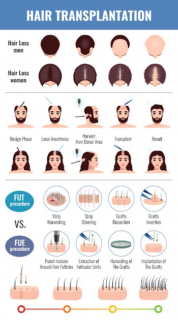 Baldness of men and women methods of hair transplantation set with infographic elements isolated Free Vector
