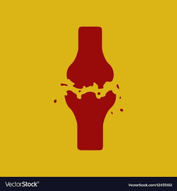 Bone fracture vector image