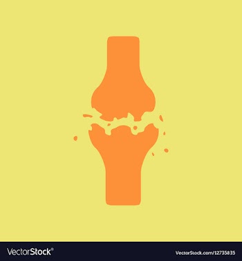 Bone fracture vector image