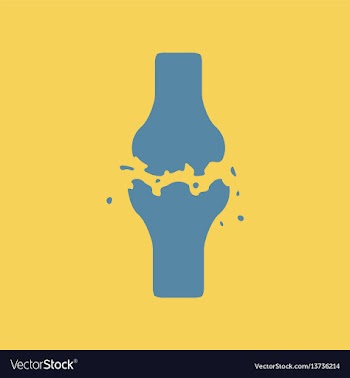 Bone fracture vector image