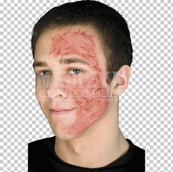 Burn Scar Contracture Wound Scarred PNG, Clipart, Acne, Bruise ...