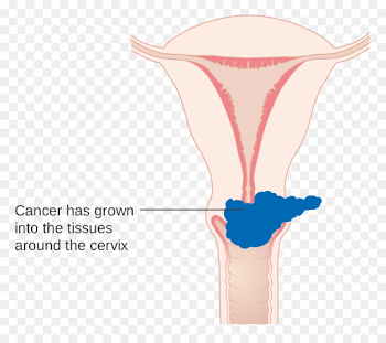 Cervical cancer staging Cervix - Cervical cancer png download ...