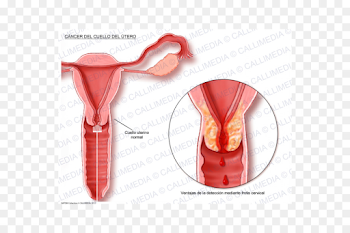 Cervical cancer Uterine cancer Cervix Uterus - utero png download ...