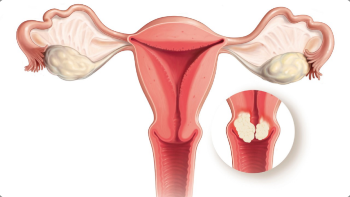 Cervical cancer, What is it?(Symptoms and causes)