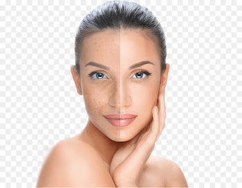 Chemical peel Facial Skin Exfoliation Surgery - mulberry 