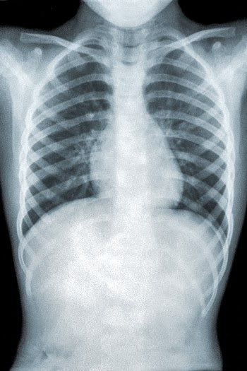 Chest x-ray of a patient | Free Photo - rawpixel