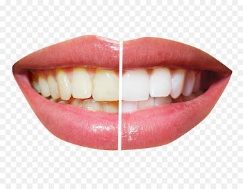 Cosmetic dentistry Tooth whitening - Teeth Whitening 