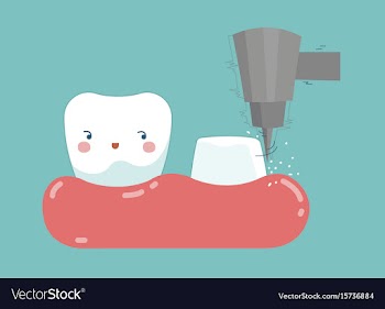 Dental crown installation process tooth and teet vector image