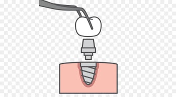 Dental implant Clothing Accessories Illustration Joke - atrophy illustration 