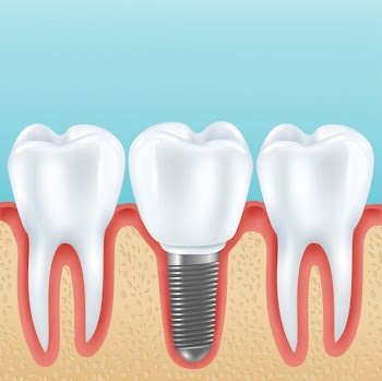 Dental prosthetics with healthy teeth Free Vector