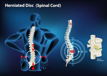 Diagram showing herniated disc in human Free Vector