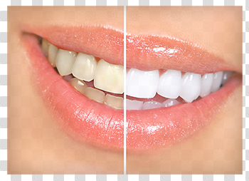Dr-Vo_teeth_whitening_houston_tx.png | Affordable Denistry