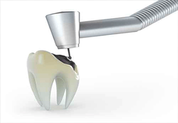 Endodontics.png | Affordable Denistry