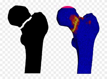 Example Of Femoral Fracture Prediction - Radboud University Medical Center
