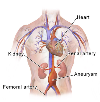 File:Abdominal Aortic Aneurysm Location.png - Wikimedia Commons