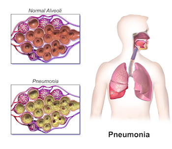 File:Blausen 0994 Pneumonia.png - Wikimedia Commons
