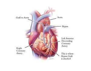 First Female in PNG to Undergo Cardiac Bypass Surgery - EMTV Online