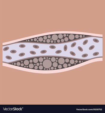 Flat vienna human atherosclerosisthe structure of vector image