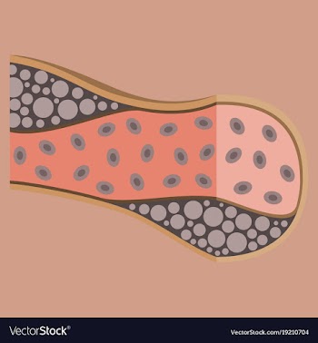Flat vienna human atherosclerosisthe structure of vector image