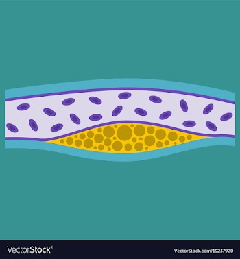 Flat vienna human atherosclerosisthe structure of vector image