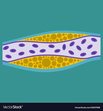 Flat vienna human atherosclerosisthe structure of vector image
