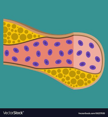 Flat vienna human atherosclerosisthe structure of vector image