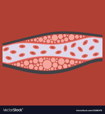 Flat vienna human atherosclerosisthe structure of vector image