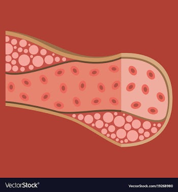 Flat vienna human atherosclerosisthe structure of vector image