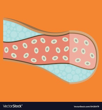 Flat vienna human atherosclerosisthe structure of vector image
