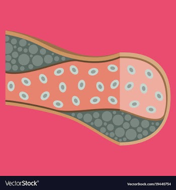 Flat vienna human atherosclerosisthe structure of vector image