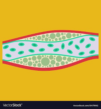 Flat vienna human atherosclerosisthe structure of vector image
