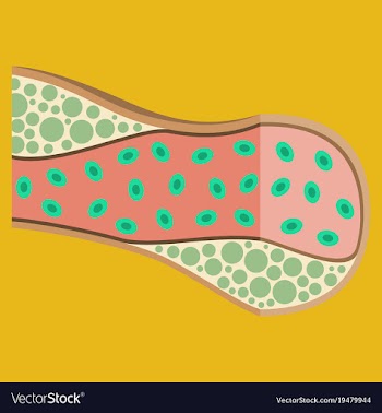 Flat vienna human atherosclerosisthe structure of vector image