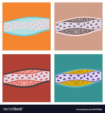 Flat vienna human atherosclerosisthe structure of vector image