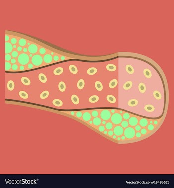 Flat vienna human atherosclerosisthe structure of vector image
