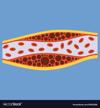 Flat vienna human atherosclerosisthe structure of vector image