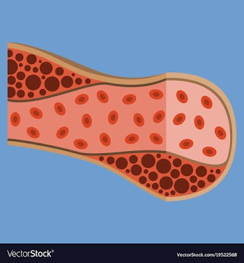 Flat vienna human atherosclerosisthe structure of vector image