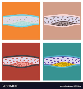 Flat vienna human atherosclerosisthe structure of vector image
