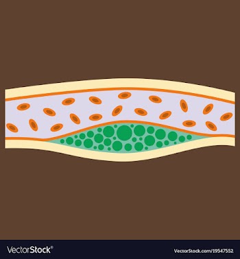 Flat vienna human atherosclerosisthe structure of vector image