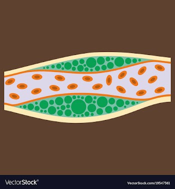 Flat vienna human atherosclerosisthe structure of vector image