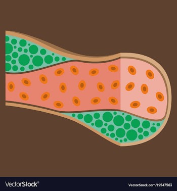 Flat vienna human atherosclerosisthe structure of vector image