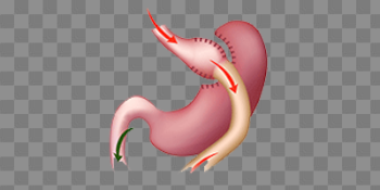 Gastric Bypass Weight Loss Bariatric Surgery
