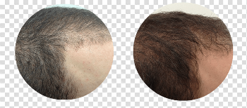 Hair Growth Transparent Image