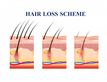Hair loss scheme Free Vector