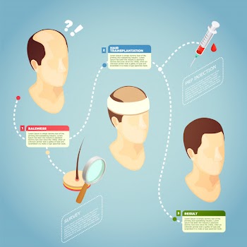 Hair transplantation vector illustration Free Vector