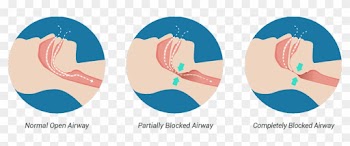 Hydrated Reduces Snoring - Causes People To Snore